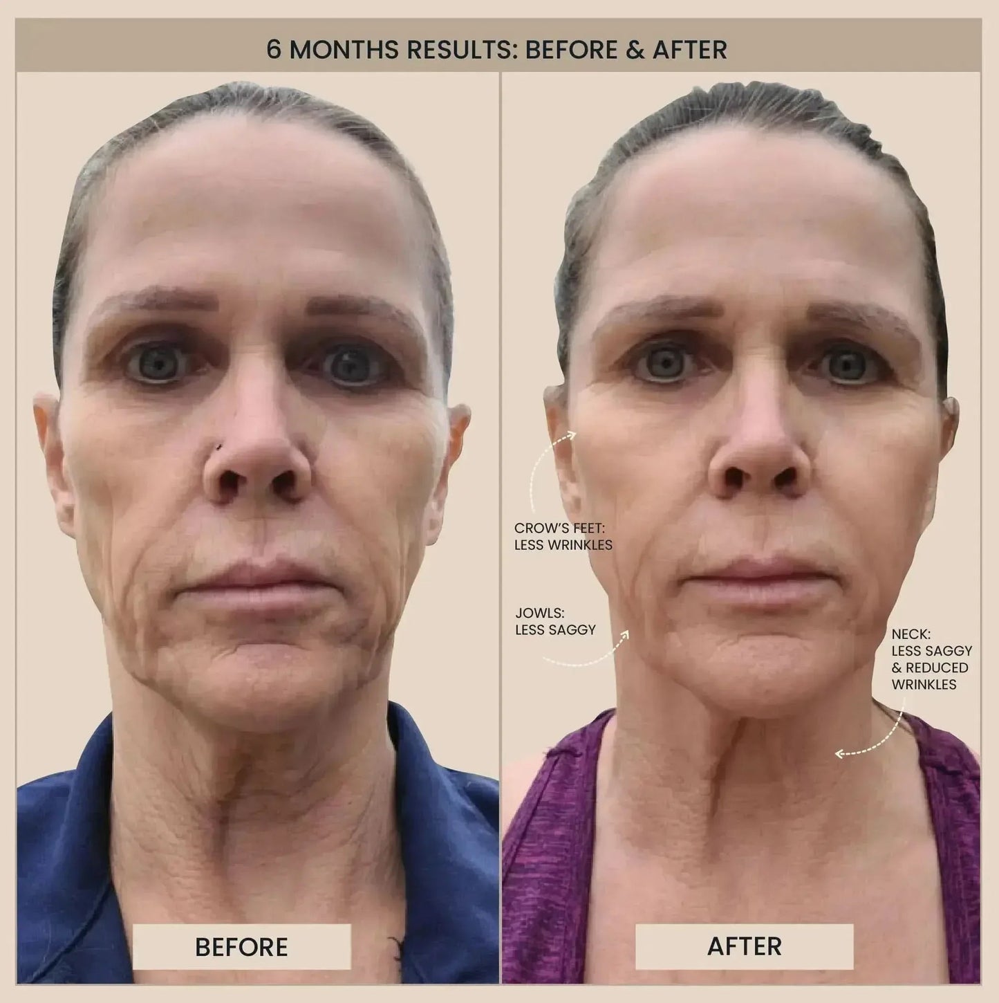 Lumo⁺ + Phoenix: Professional-Grade Skin Tightening and Lifting Duo